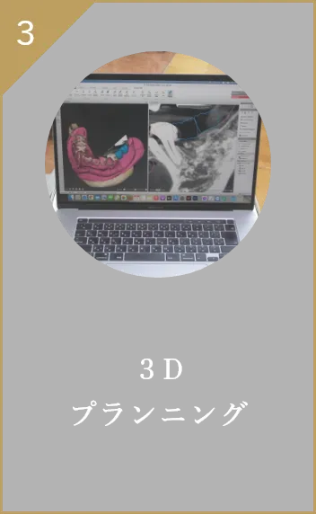 3Dプランニング