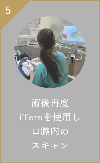 術後再度iTeroを使用し口腔内のスキャン