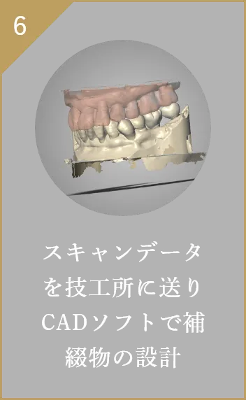 スキャンデータを技工所に送りCADソフトで補綴物の設計